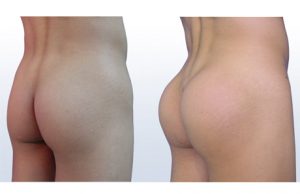 Lipofilling fesses Tunisie