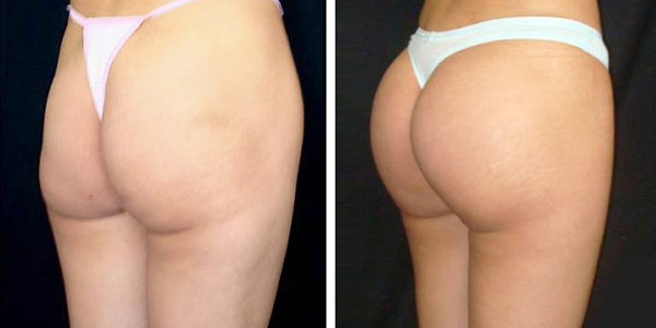 tarif implant fessier tunisie