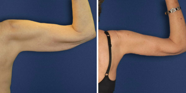 brachioplastie : chirurgie des bras