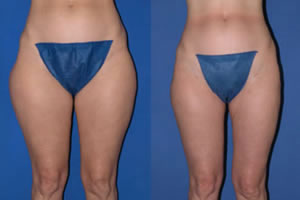 prix chirurgie des cuisses Tunisie