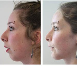 genioplastie femme avant apres