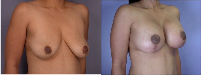 Prix lifting seins Tunisie