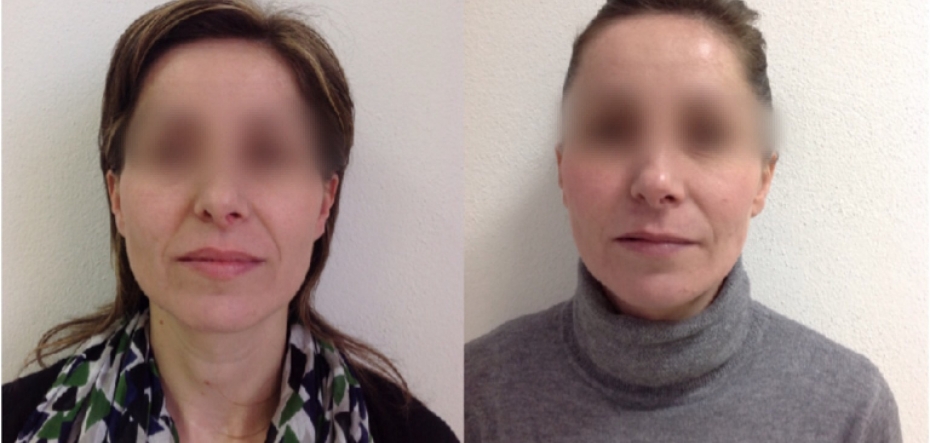 prix lifting cervico facial en Tunisie