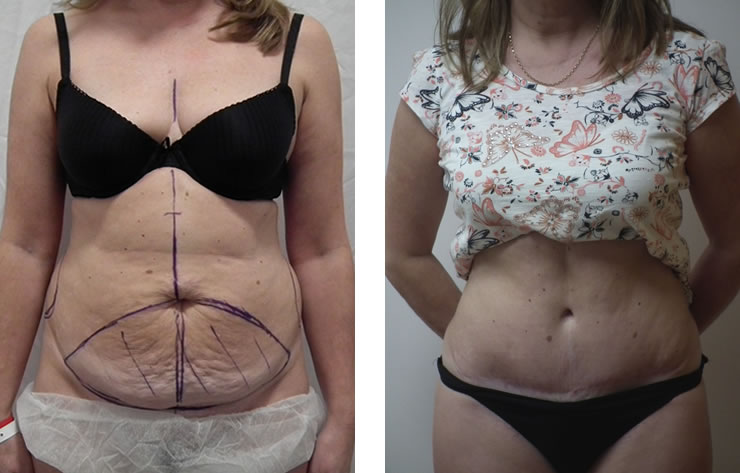 prix abdominoplastie en Tunisie