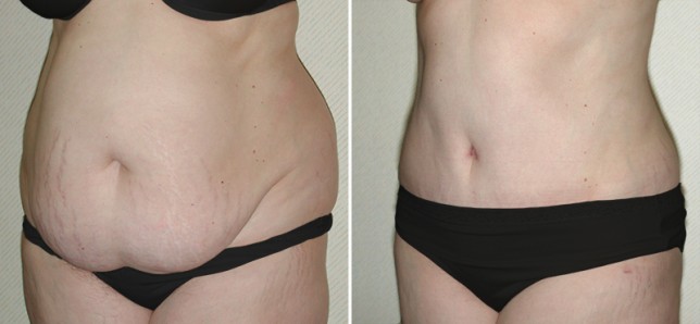 prix abdominoplastie tunisie