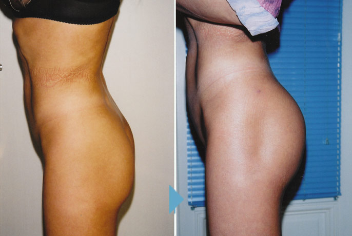 Implants fessiers en Tunisie
