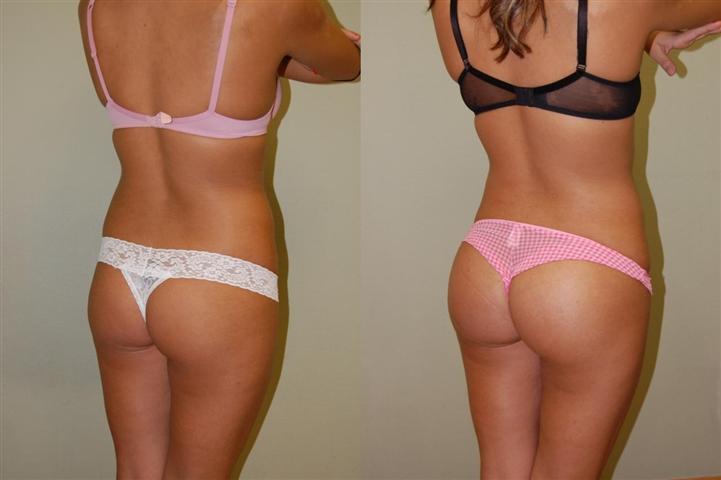 prix augmentation fesses Tunisie