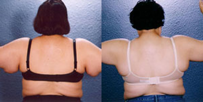 prix lifting bras en Tunisie