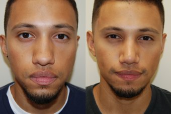 Rhinoplastie Tunisie prix pas cher