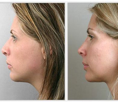 Prix rhinoplastie Tunisie
