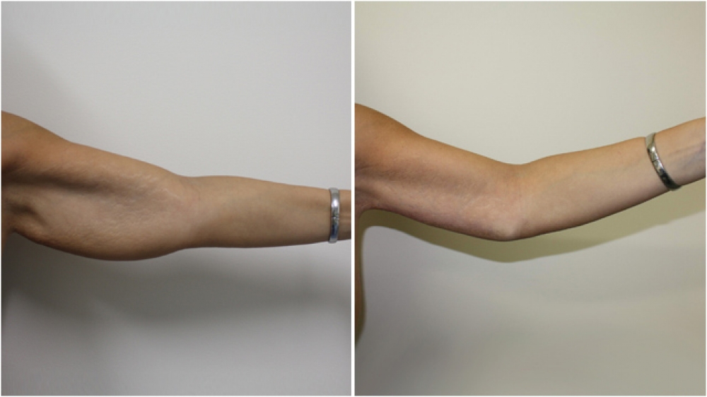 chirurgie esthétique des bras
