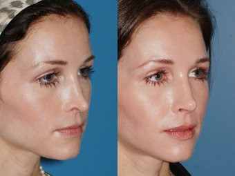 Rhinoplastie correction Turquie prix