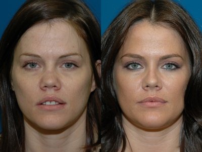Rhinoplastie medicale Tunisie