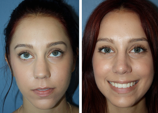 Rhinoplastie medicale en Tunisie