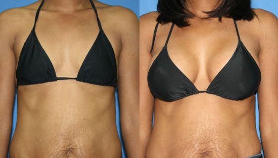 implants mammaires Tunisie