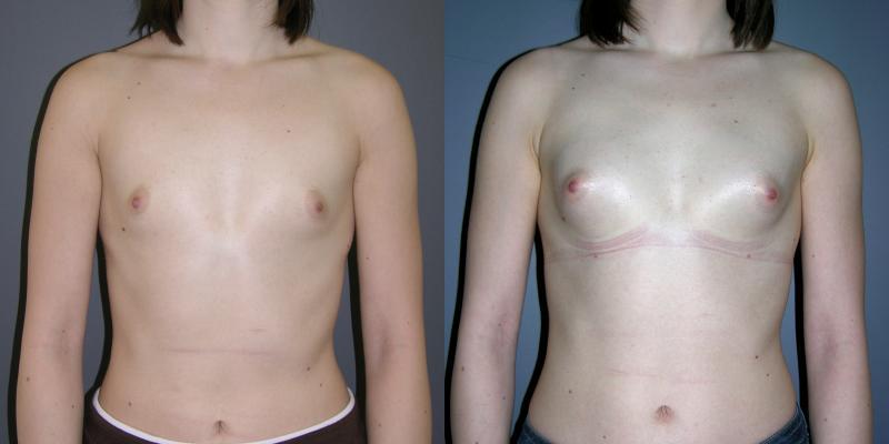 lipofilling mammaire Tunisie