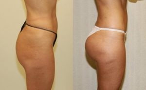 lipofilling fesses pas cher