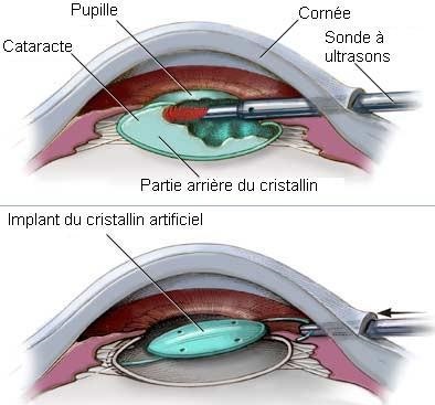 Blépharoplastie prix