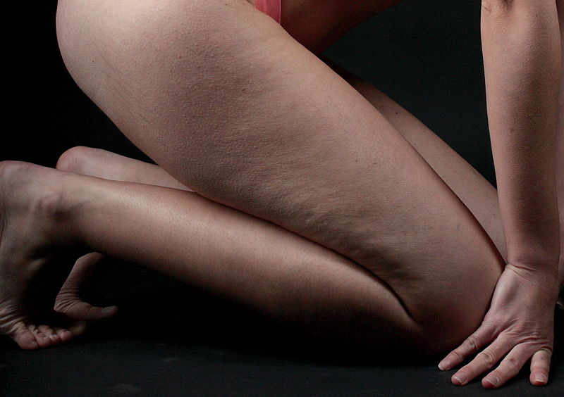 Comment enlever la cellulite des cuisses avec la liposuccion