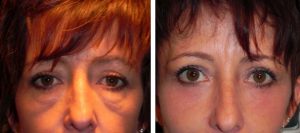 Blepharoplastie laser en Turquie