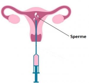 Insemination artificielle turquie