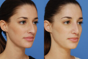 Rhinoplastie correction Turquie