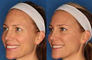 botox Turquie