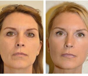 lifting du visage Turquie