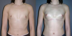 Lipofilling mammaire Turquie
