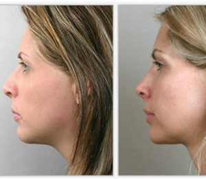 rhinoplastie en Turquie