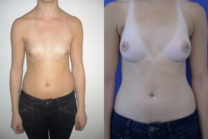 tarif Lipofilling mammaire Turquie