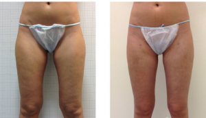 tarif Liposuccion Turquie