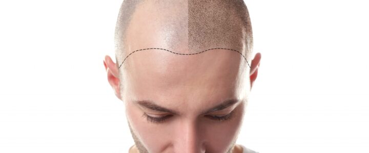 Micropigmentation cheveux : Qu’est-ce que la micropigmentation du cuir chevelu?